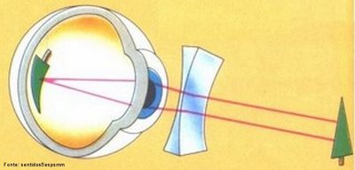 Lente que permite divergir ligeiramente os raios luminosos antes de chegarem  crnea, possibilitando a formao do ponto focal na retina. Utilizada na correo da miopia, dificuldade para enxergar de longe.
<br /><br />
Palavras-chave: tica, viso, lentes, divergentes, cncava, miopia, correo.