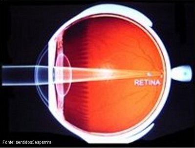 O astigmatismo é a situação na qual a córnea possui uma superfície irregular, ao invés da forma esférica angular, que leva a uma refração desigual dos raios luminosos, não originando nenhum ponto focal. Esta imperfeição compensa-se através do uso de lentes cilíndricas, que permitem a convergência de apenas alguns raios luminosos, permitindo a criação de um ponto focal na retina do olho.
<br /><br />
Palavras-chave: Retina, ótica, lentes, convergência, visão, raios, luminosos, córnea.