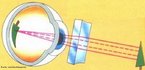 Lente que faz com que os raios de luz se concentrem em um plano nico. Serve para corrigir problemas de astigmatismo, uma deficincia visual causada pelo formato irregular da crnea ou do cristalino, formando uma imagem em vrios focos que se encontram em eixos diferenciados. <br /><br /> Palavras-chave: tica, viso, lentes, cilndricas, astigmatismo, deficincia, crnea, correo.